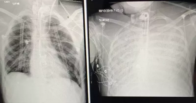 Doctors at Henry Ford Hospital performed a double-lung transplant on a Michigan teen after he sustained injuries from vaping, but won't say what he was vaping. - Henry Ford Health System