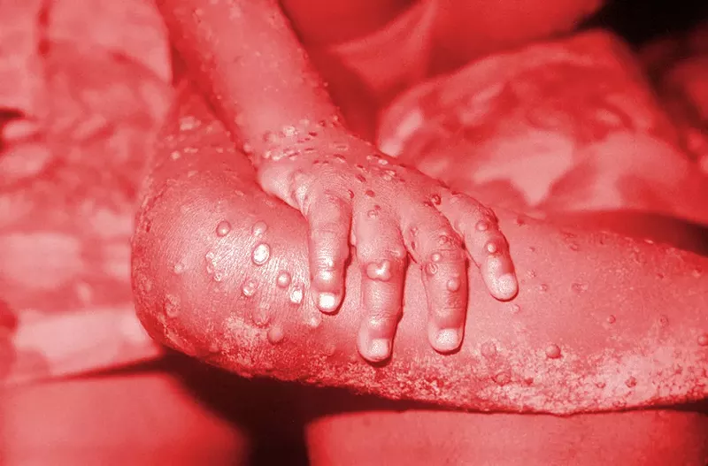 Our society can’t handle another mass-scale pandemic like COVID. Right now, monkeypox is showing us just how unprepared we are. - Shutterstock