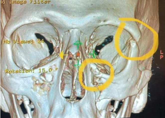 An X-ray image shows damage to Daniel Reiff’s eye after a Clinton Township cop punched him in the face. - Courtesy of Marko Law