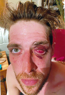 Daniel Reiff’s injury to his eye. - Courtesy of Marko Law