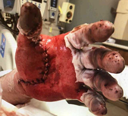 Brian Mierendorf sustained serious injuries to his hands. - Courtesy of Marko Law