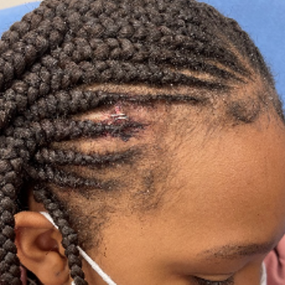 The 11-year-old girl was struck with a metal hockey stick in gym class.